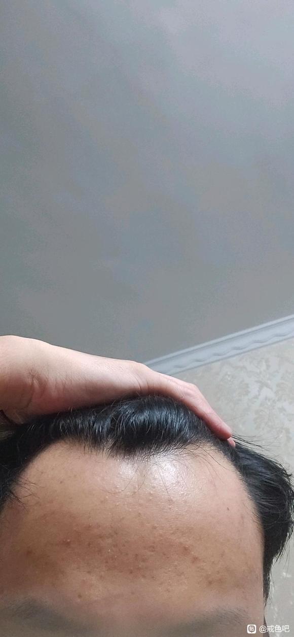 ”seyu是我脱发秃顶只是其中最轻的一个病症