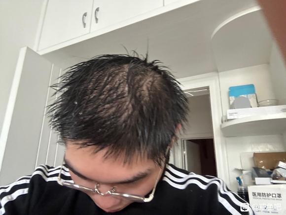 ”求各位老哥指教一下，我这种头发脱发戒色能恢复吗