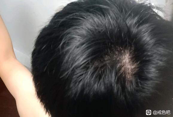 ”掉头发严重