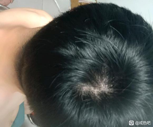 ”掉头发严重