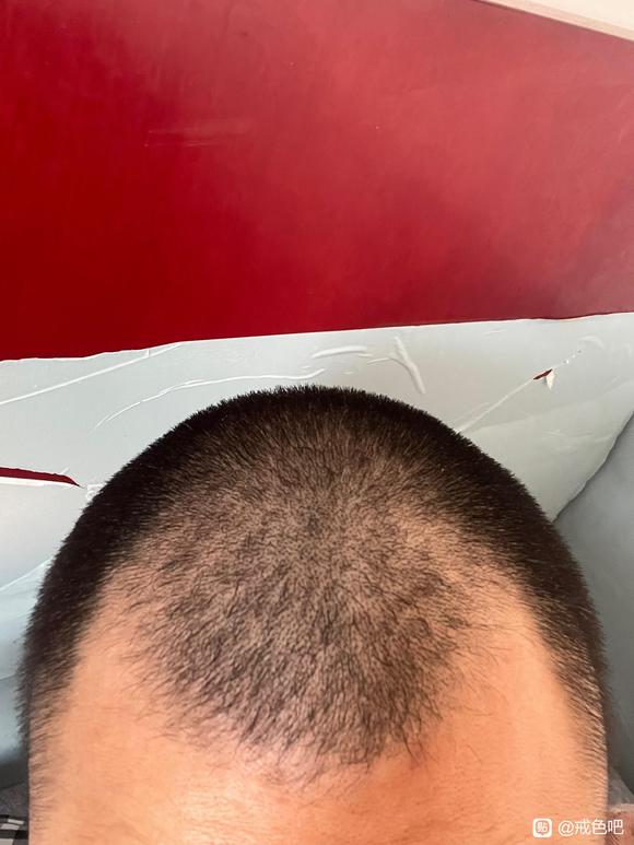 ”脱发严重了，怎么办，还有救吗？