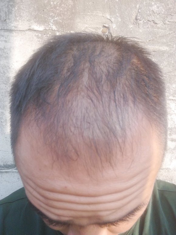 ”戒了快一年了，精神状态越来越好，体力也越来越好，头发恢复了不