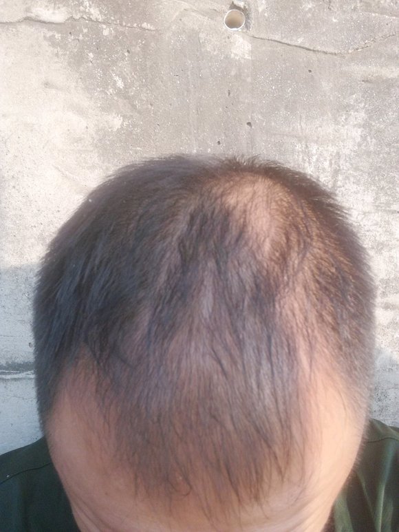 ”戒了快一年了，精神状态越来越好，体力也越来越好，头发恢复了不