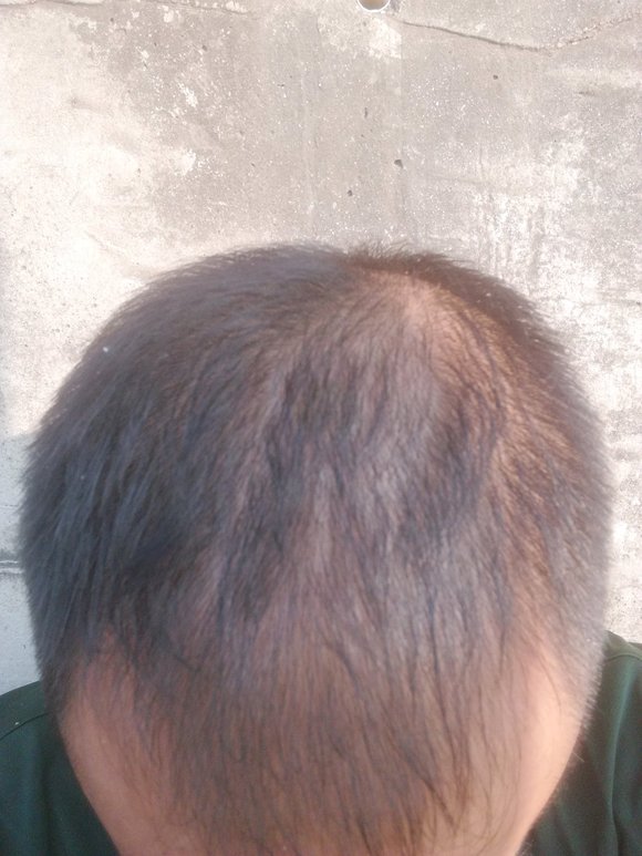 ”戒了快一年了，精神状态越来越好，体力也越来越好，头发恢复了不