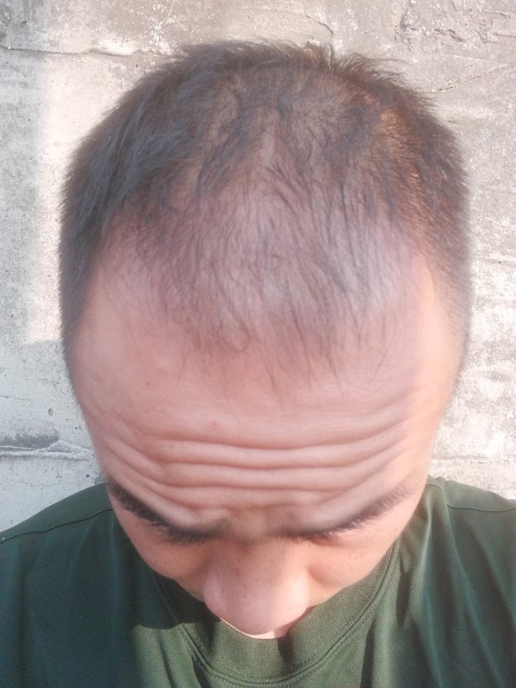 ”戒了快一年了，精神状态越来越好，体力也越来越好，头发恢复了不