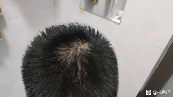 ”脱发白发多长时间才能恢复呢