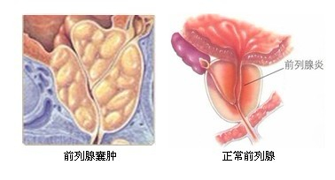 ”纵欲的前列腺