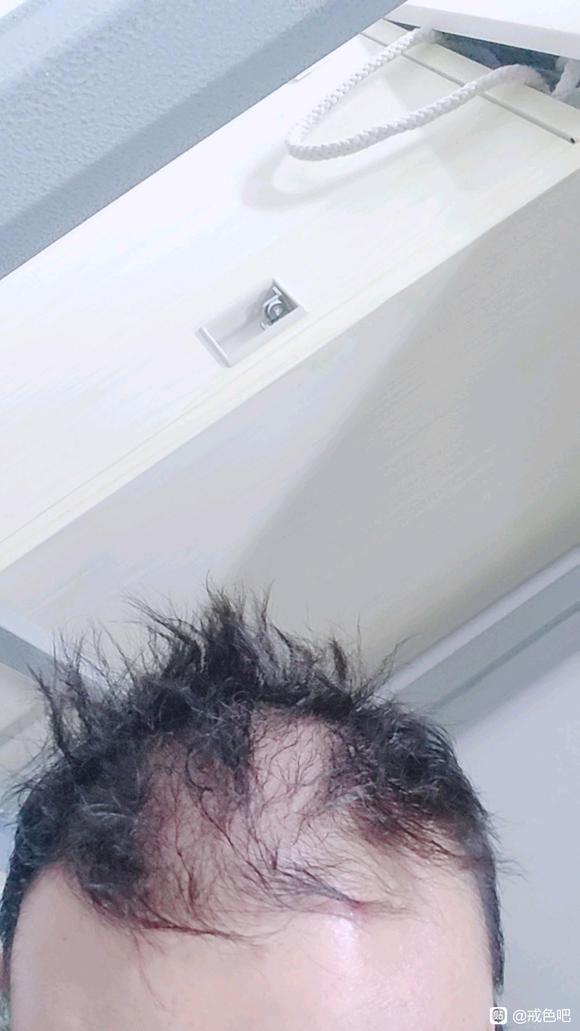 ”戒色真的能治掉头发吗