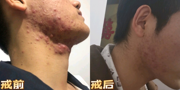 ”戒色半年，痘痘恢复了