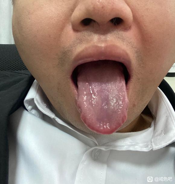 ”这样能缓解精索静脉曲张吗