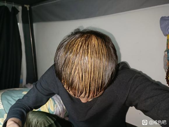 ”sy脱发很严重还可以恢复吗