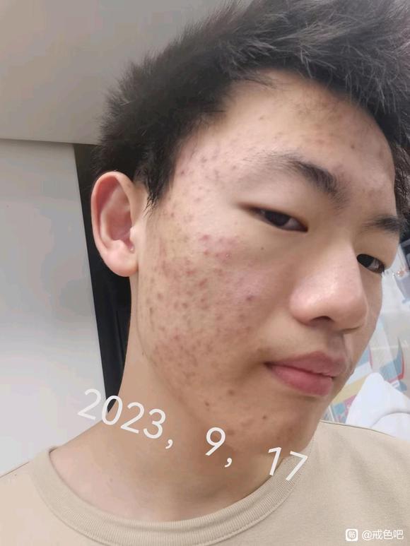 ”戒色，痘痘，