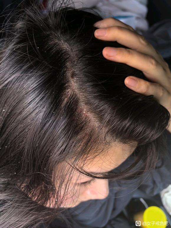 ”我头皮痒头皮屑每天抠像猪油渣，抠完又长。抠一地，有办法解决不？