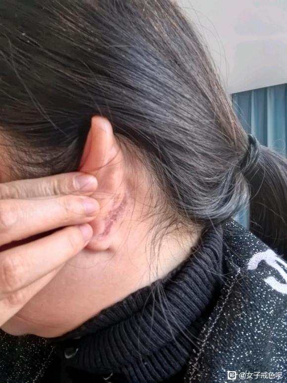 ”我头皮痒头皮屑每天抠像猪油渣，抠完又长。抠一地，有办法解决不？