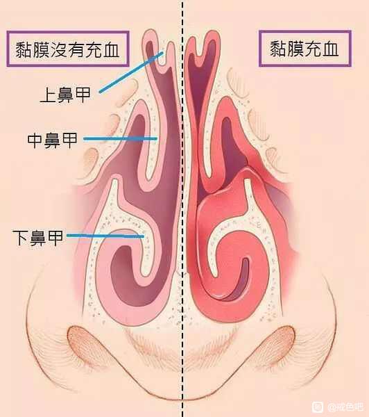 ”鼻粘膜充血戒色后能恢复吗？
