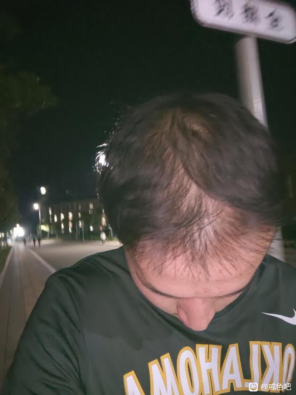 ”sj导致脱发非常严重，请问还能恢复吗？