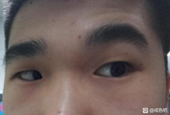 ”求助，眼圈周围总是围绕着一圈紫红色，困扰我好几年了，怎么回事啊