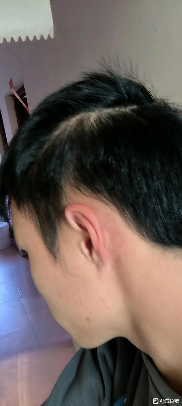 ”16岁开始掉发