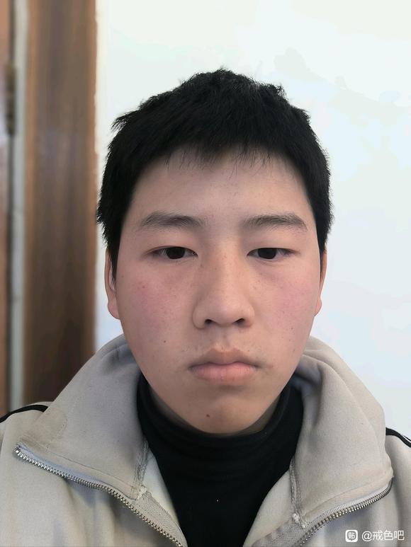 ”真诚求助各位大佬本人今年17岁从去年接触sy然后脸就变成这样了