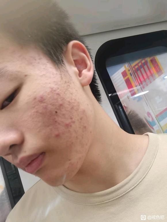 ”戒色，痘痘，