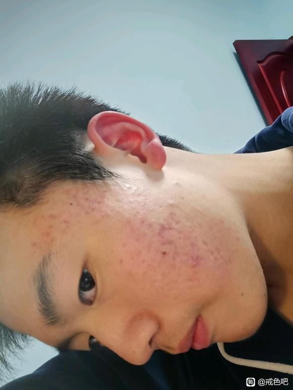 ”戒色，痘痘，