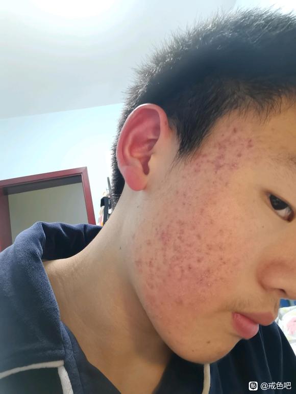 ”戒色，痘痘，