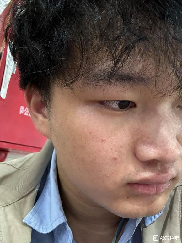 ”【邪淫危害】怎么恢复成好的皮肤状态？？？求求求！！！