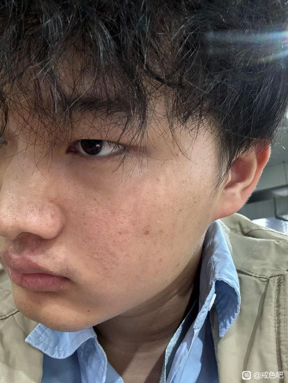 ”【邪淫危害】怎么恢复成好的皮肤状态？？？求求求！！！