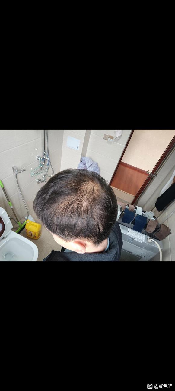 ”21岁脱发已经很严重了