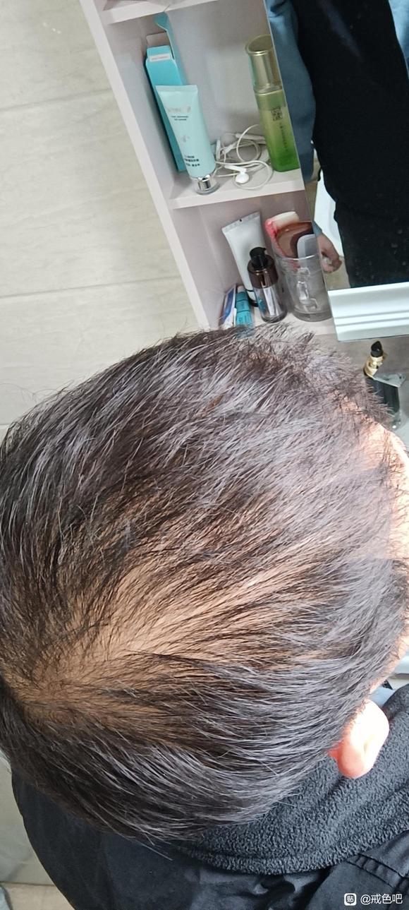 ”21岁脱发已经很严重了
