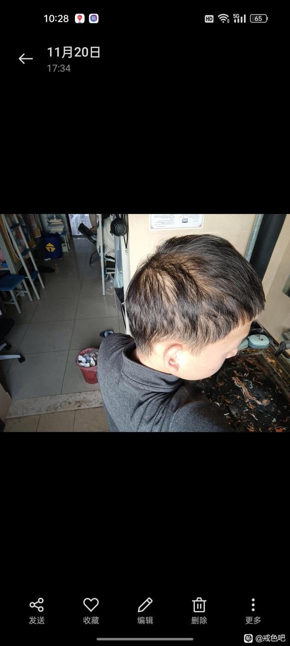 ”21岁脱发已经很严重了