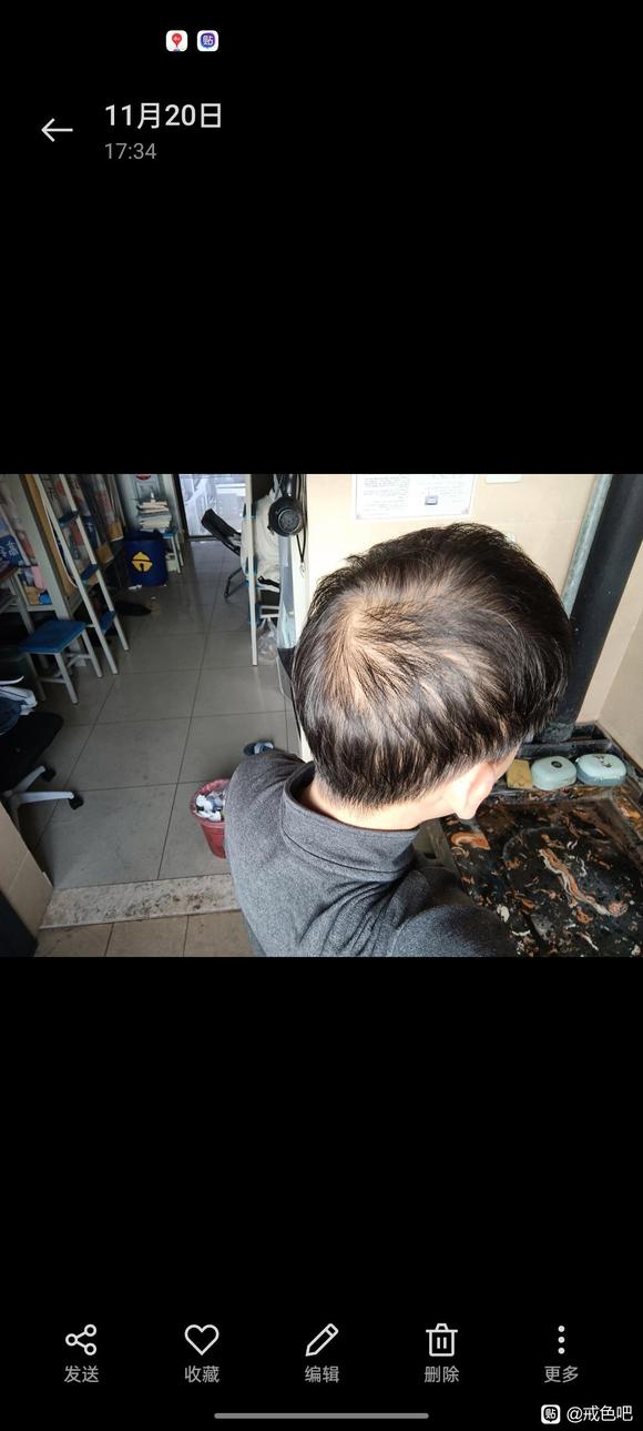 ”21岁脱发已经很严重了