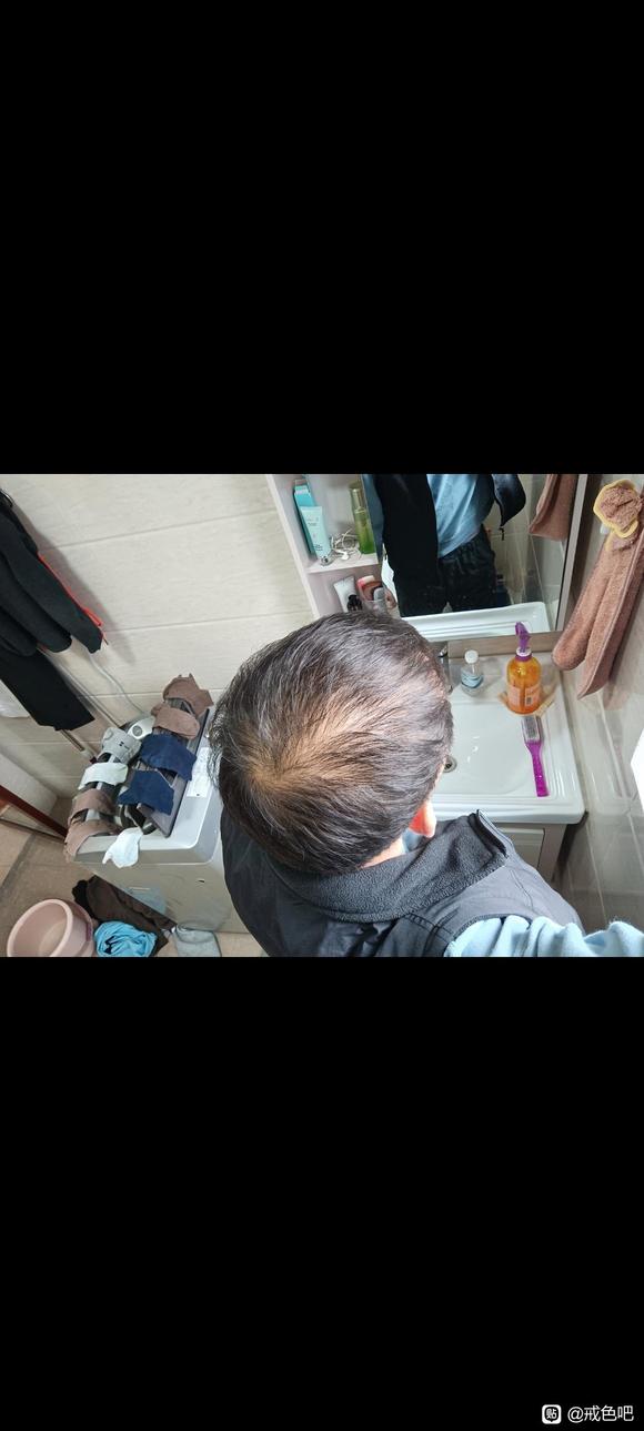 ”21岁脱发已经很严重了