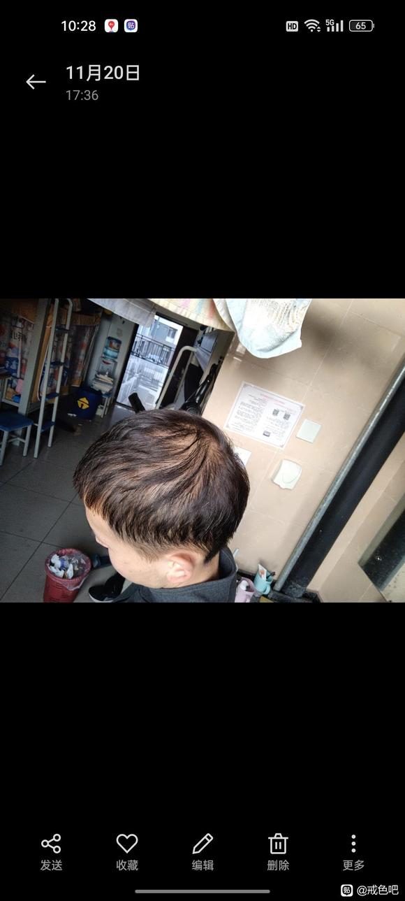 ”21岁脱发已经很严重了