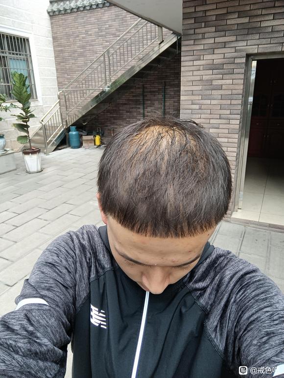 ”21岁脱发已经很严重了