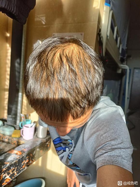 ”21岁脱发已经很严重了