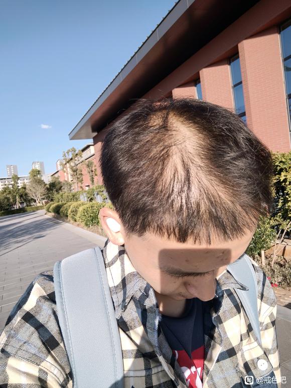 ”21岁脱发已经很严重了