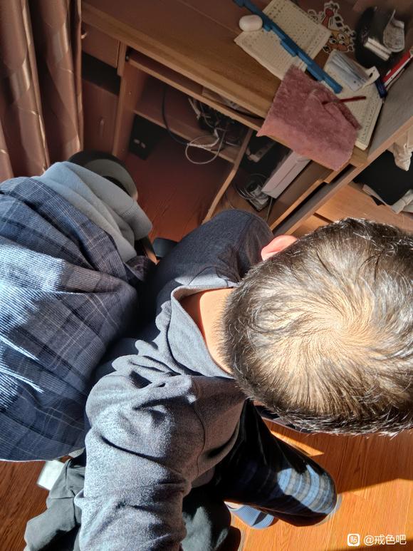 ”21岁脱发已经很严重了