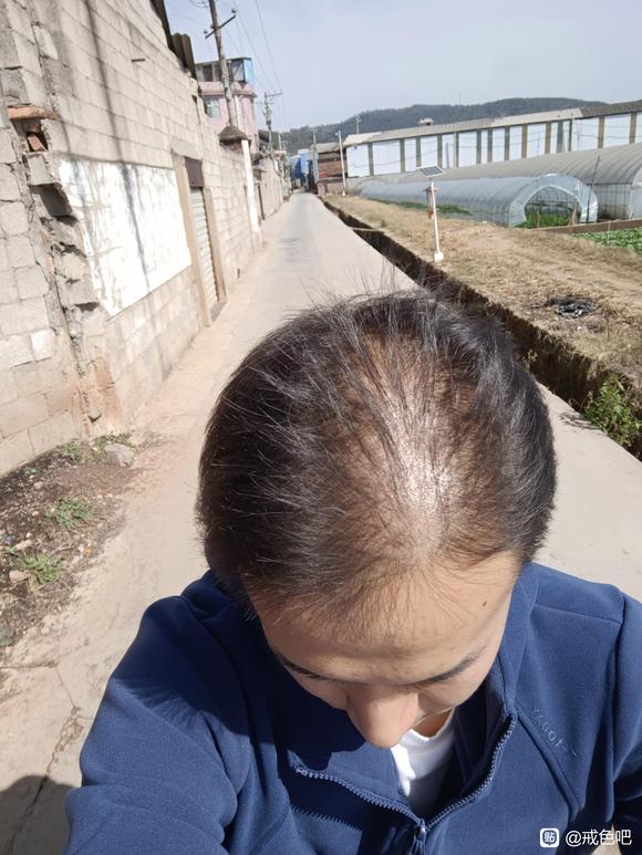 ”21岁脱发已经很严重了