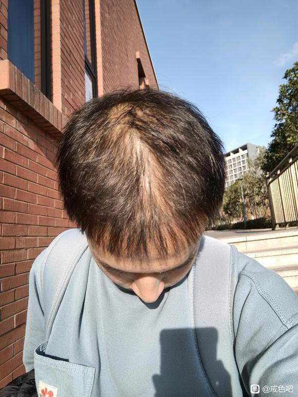 ”21岁脱发已经很严重了