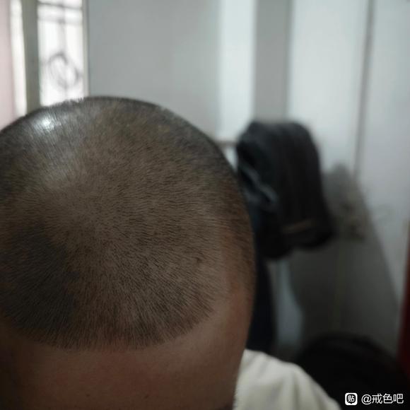 ”头发快掉光了，还能恢复吗