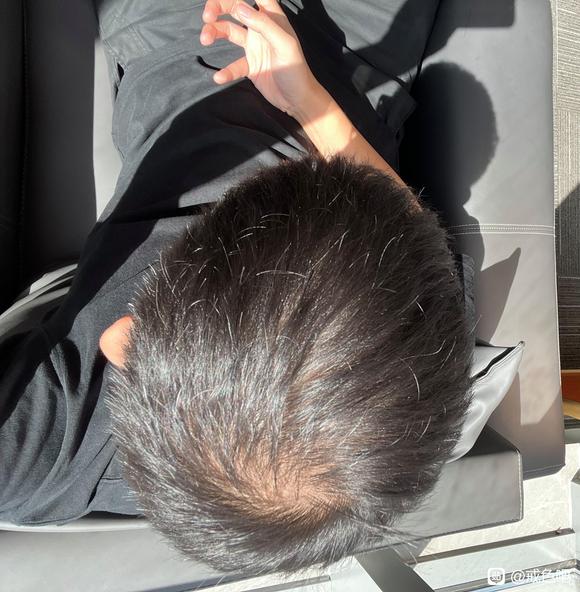 ”脱发怎么才能恢复？每天洗完头脱发10-30根