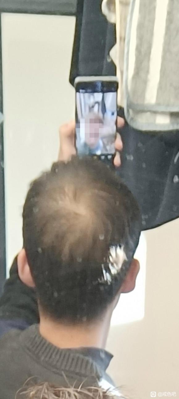 ”脱发严重还能恢复吗？