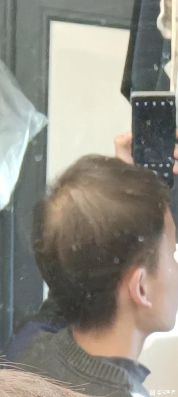 ”脱发严重还能恢复吗？