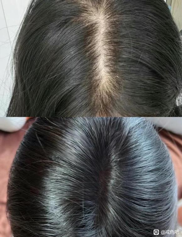 ”脱发严重还能恢复吗？