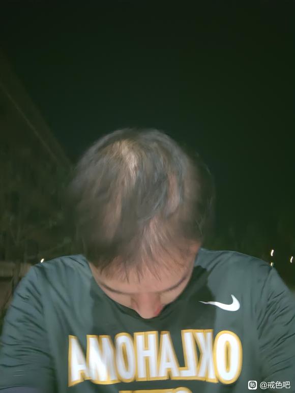 ”sj导致脱发非常严重，请问还能恢复吗？