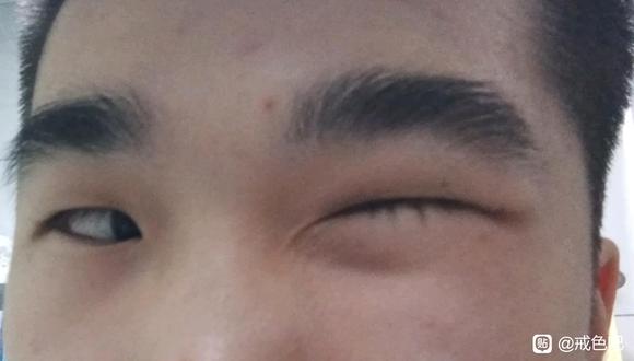 ”求助，眼圈周围总是围绕着一圈紫红色，困扰我好几年了，怎么回事啊