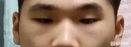 ”求助，眼圈周围总是围绕着一圈紫红色，困扰我好几年了，怎么回事啊