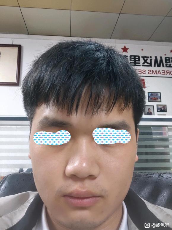 ”撸了好几年了，黑眼圈很严重，怎么恢复啊