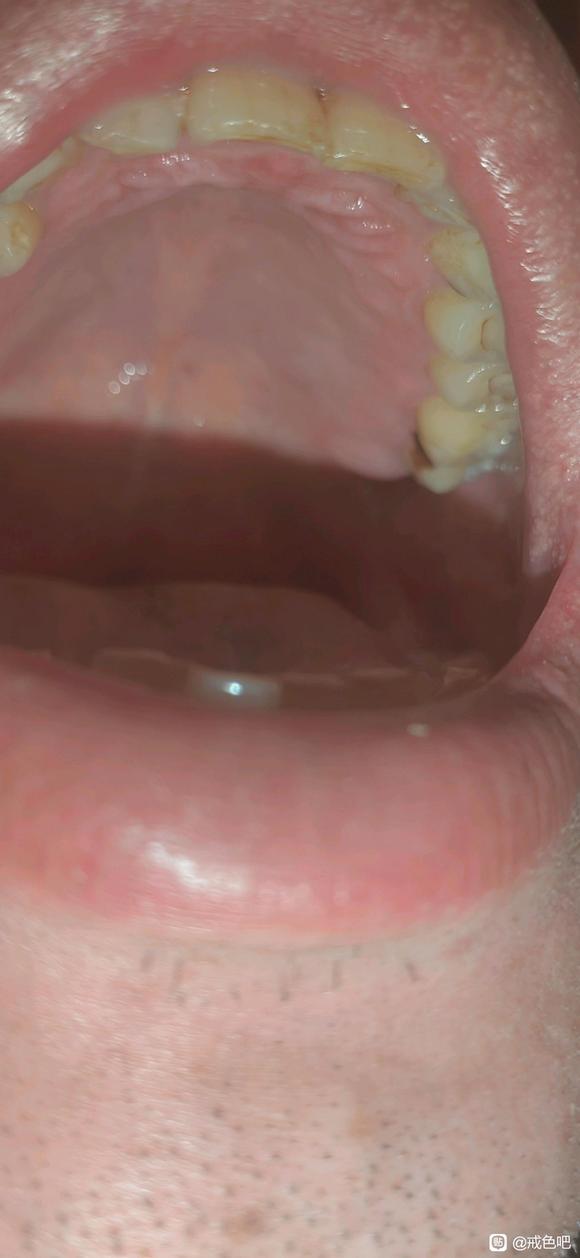 ”最近咽炎难受的吃中药都没有效果虚火大的牙龈红肿